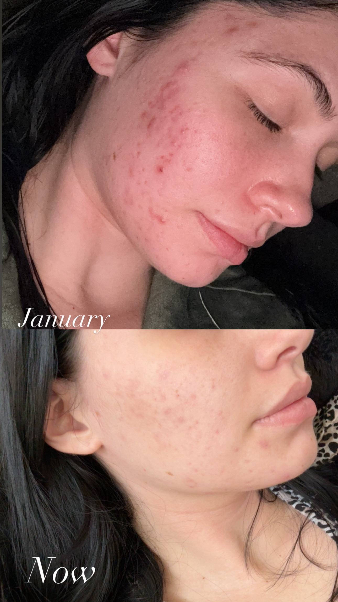 Acne transformation before and after