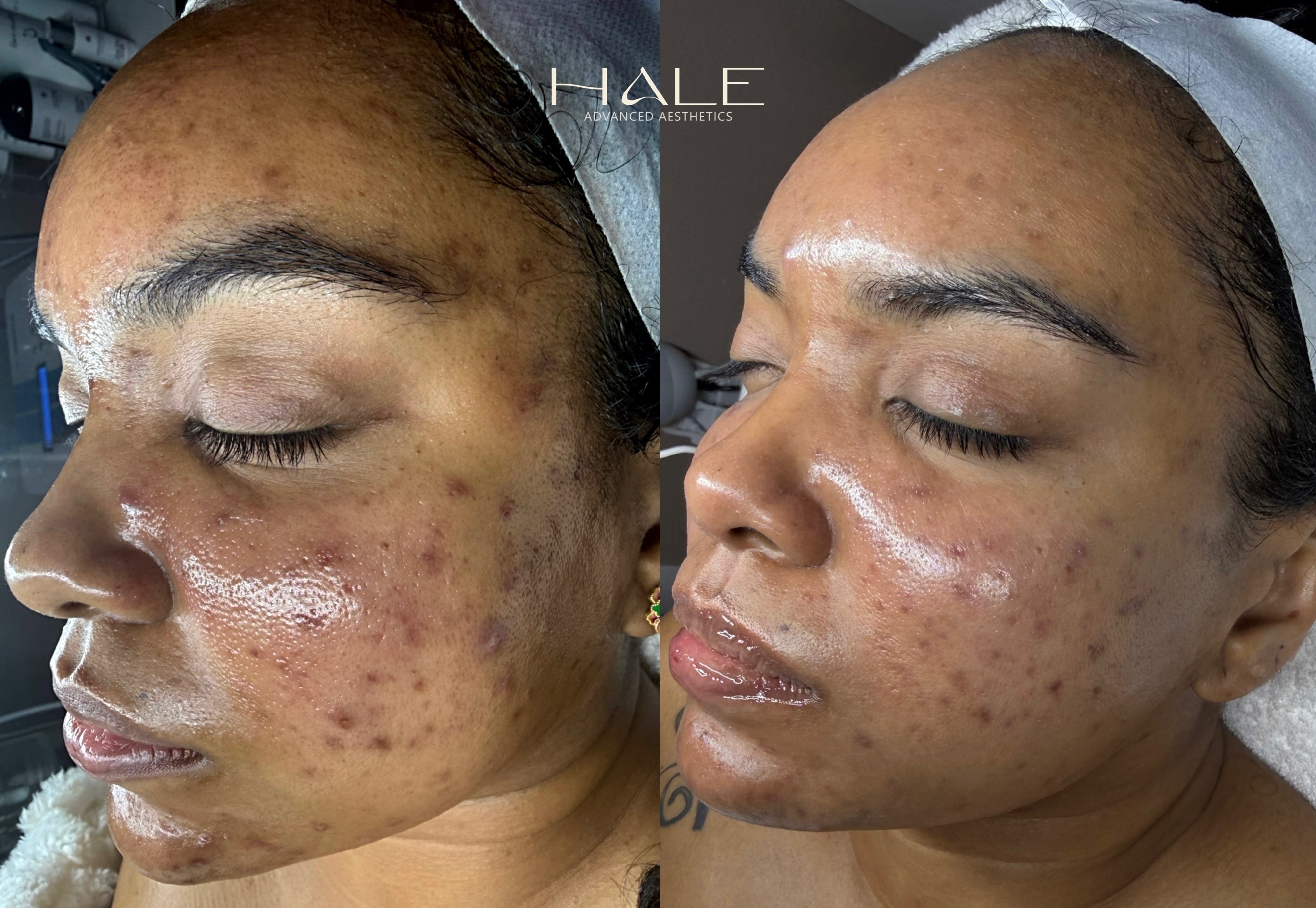 Lifting and firming before and after