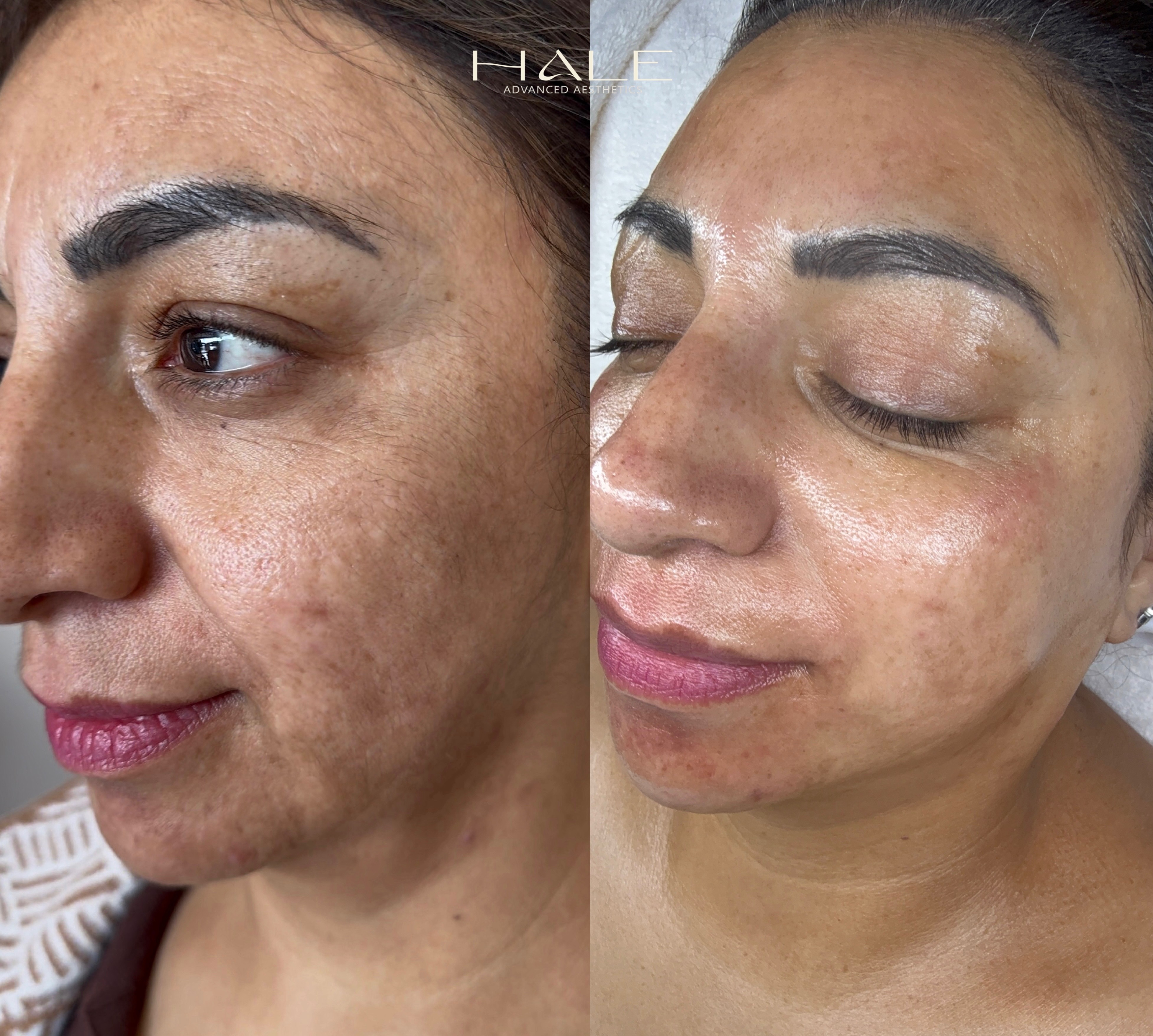 Skin texture and radiance before and after