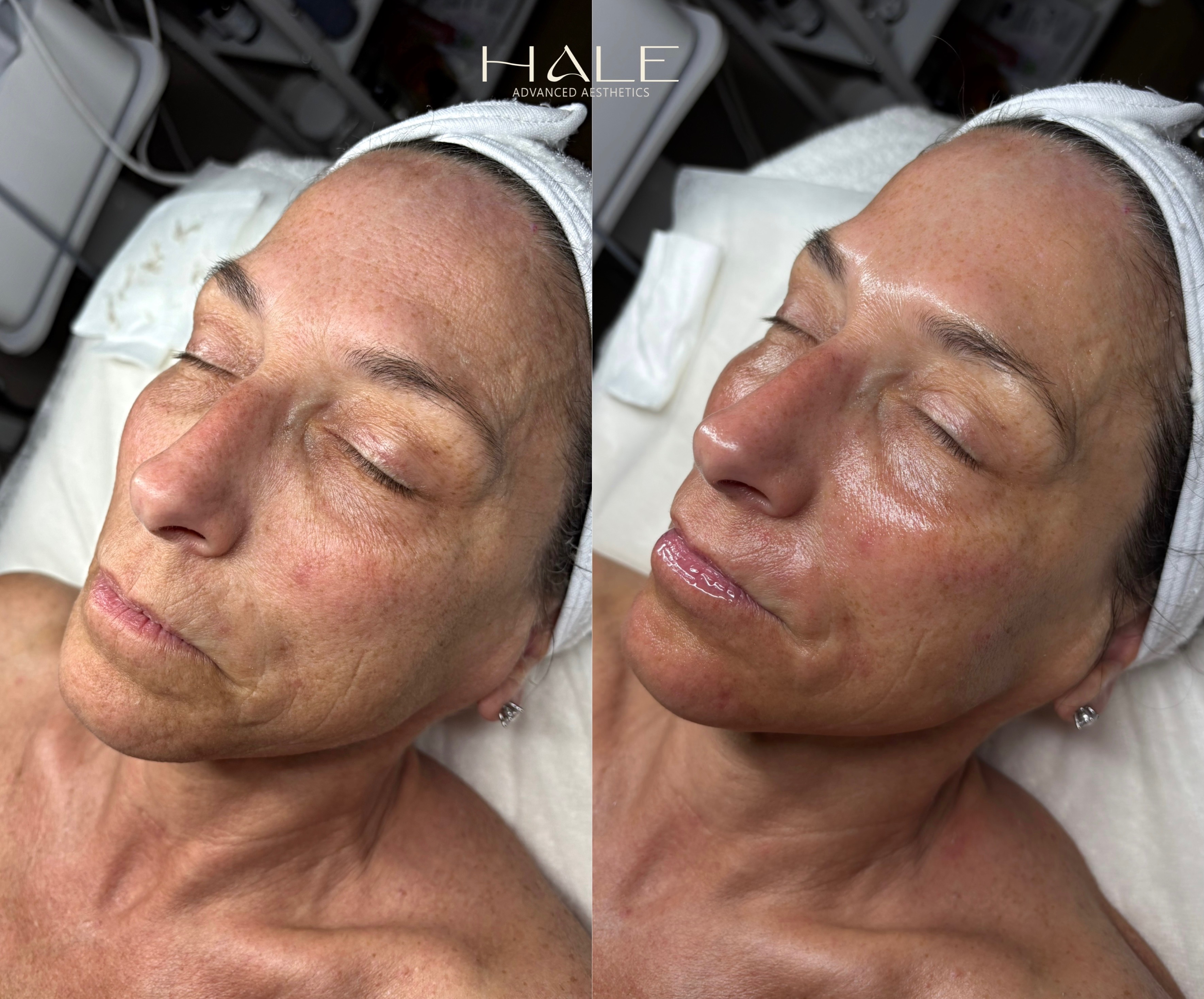 Acne treatment before and after