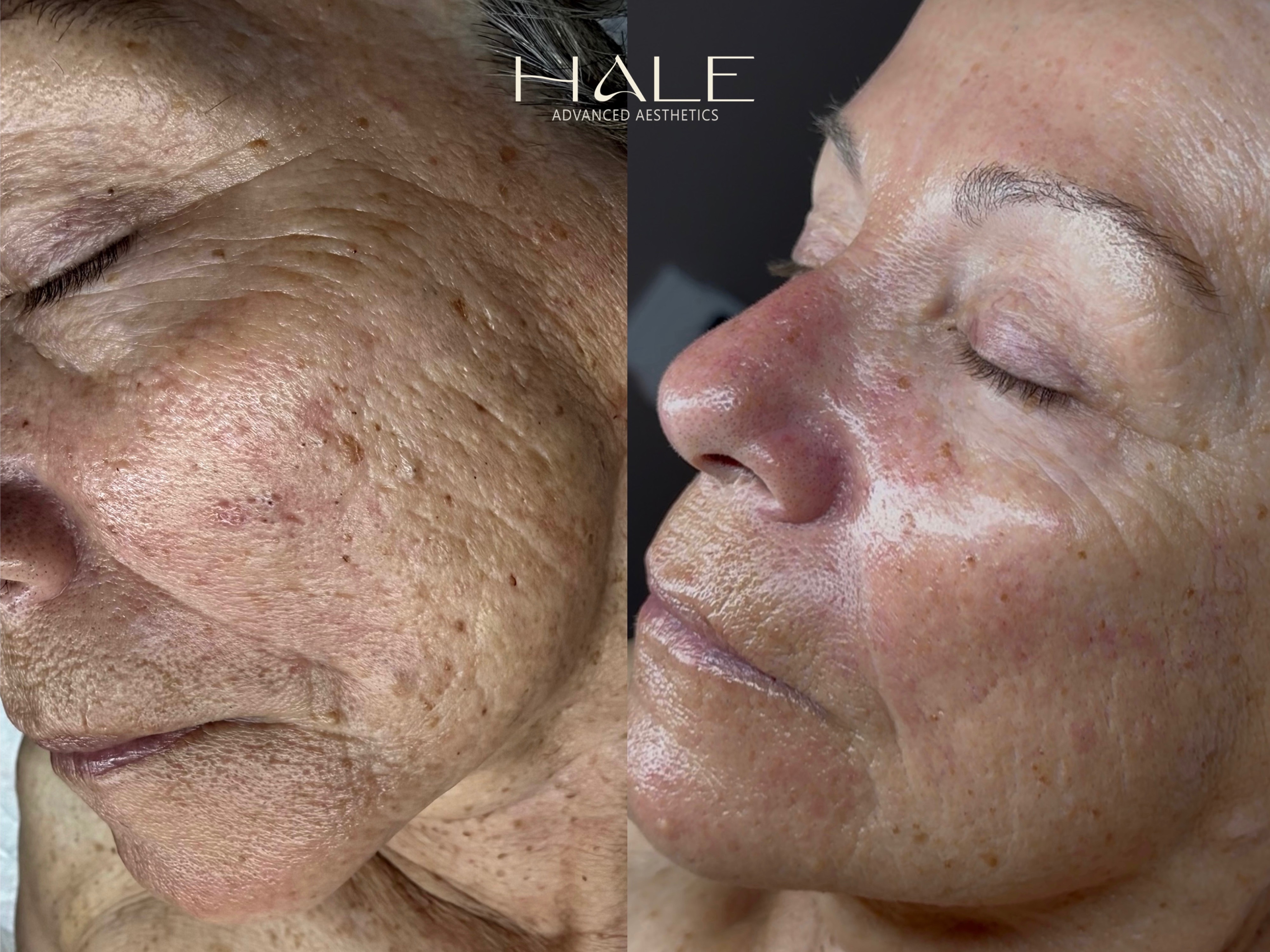 Pores and congestion before and after